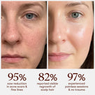 Split-screen skin texture before and after comparison detailing clear dermal improvement next to key data points: 95% saw a reduction in acne scars, 82% reported hair regrowth, and 97% experienced trauma-free sessions.  