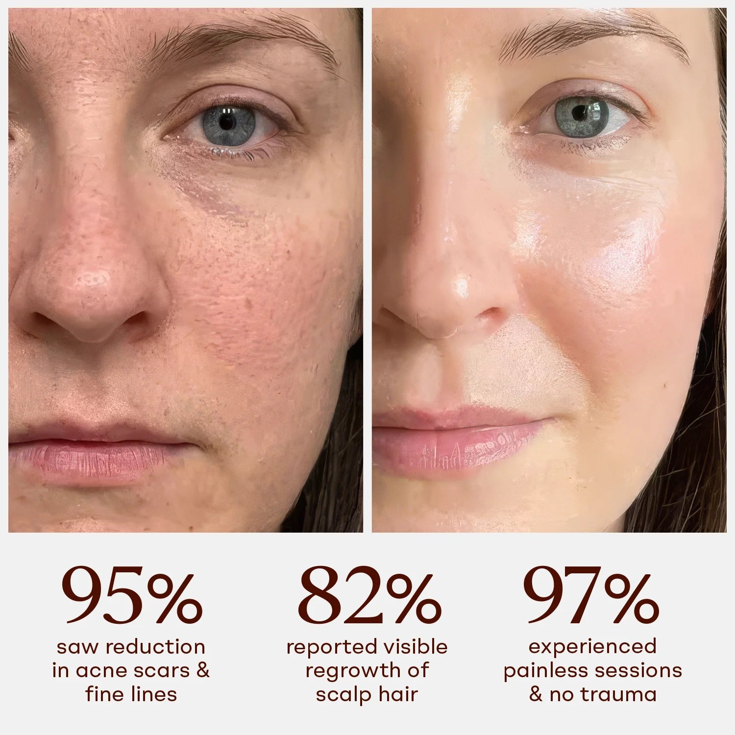 Split-screen skin texture before and after comparison detailing clear dermal improvement next to key data points: 95% saw a reduction in acne scars, 82% reported hair regrowth, and 97% experienced trauma-free sessions.  